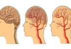 脑供血不足会引起痴呆吗？脑供血不足患者注意营养均衡