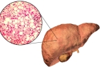 丙肝患者是怎么患的脂肪肝 丙肝发展成脂肪肝原因有四