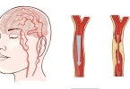 脑梗塞患者适合吃绿豆吗？脑梗塞患者康复后需要注意什么？