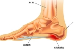 脚痛可能原因及处理方式