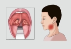 扁桃体发炎左边脖子疼痛怎么办