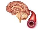 头脑血管堵塞严重吗